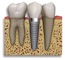 image_Dental Implants