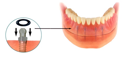 Denture secured by mini implants